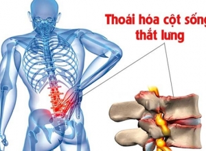 Bệnh Thoái Hoá Cột Sống Thắt Lưng Là Gì ? Triệu Chứng Và Cách Phòng Ngừa